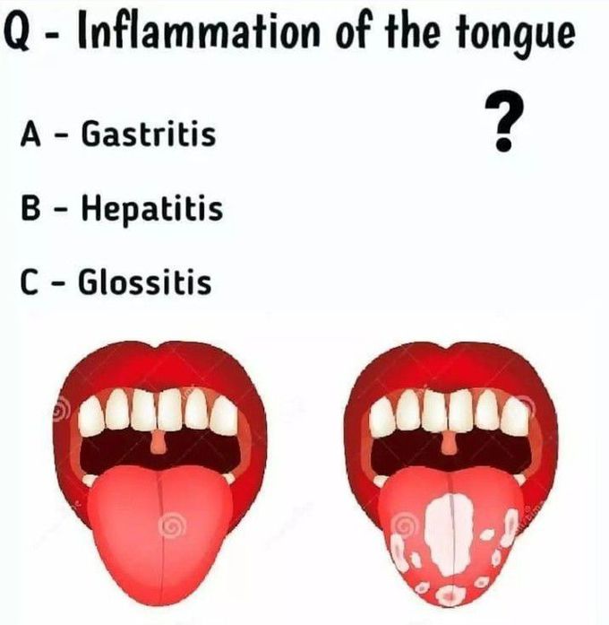 Inflammation of tongue is called?