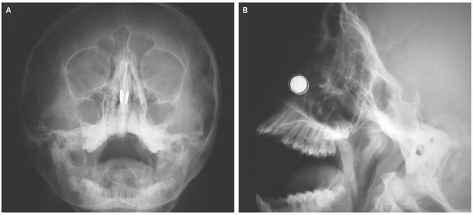 Button Magnets in the Nasal Cavity