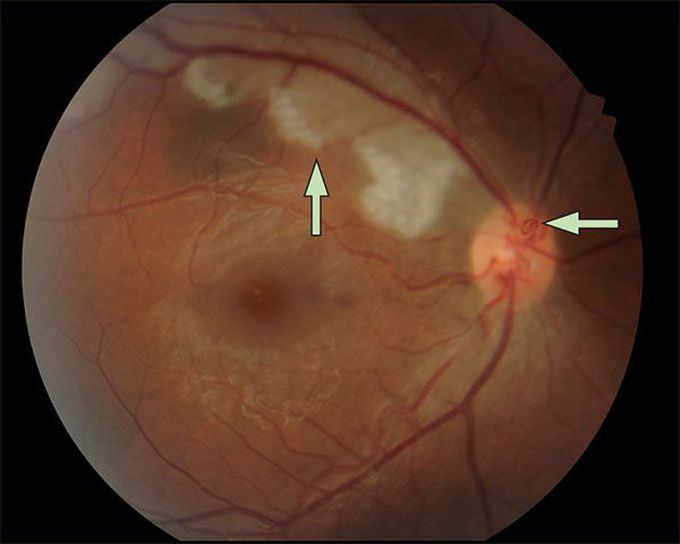 Keeping an eye out for systemic disease