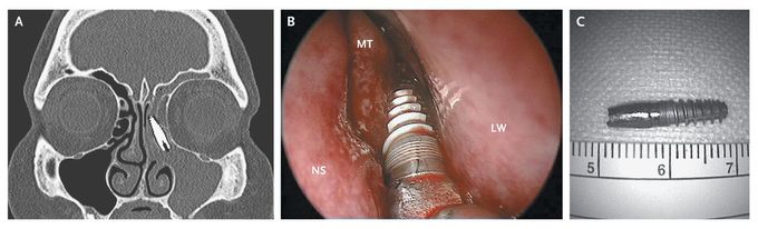 Dental Implant in the Ethmoid Sinus