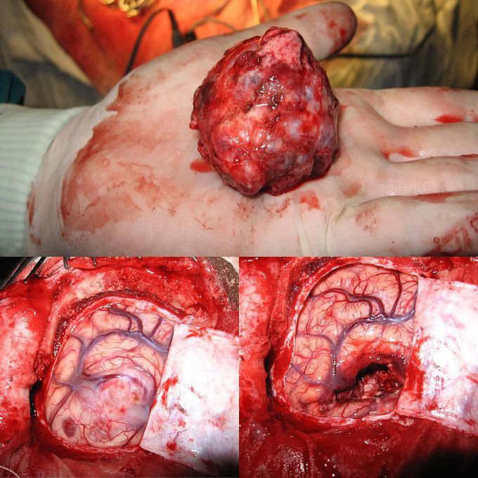 Egg size meningioma removed from the brain! 