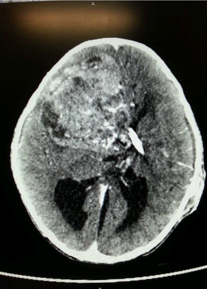 Neurosurgery