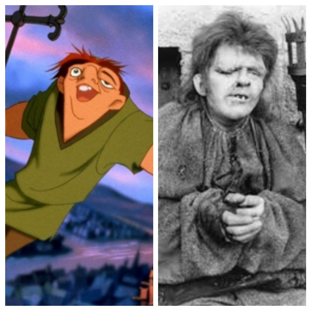 real life hunchback