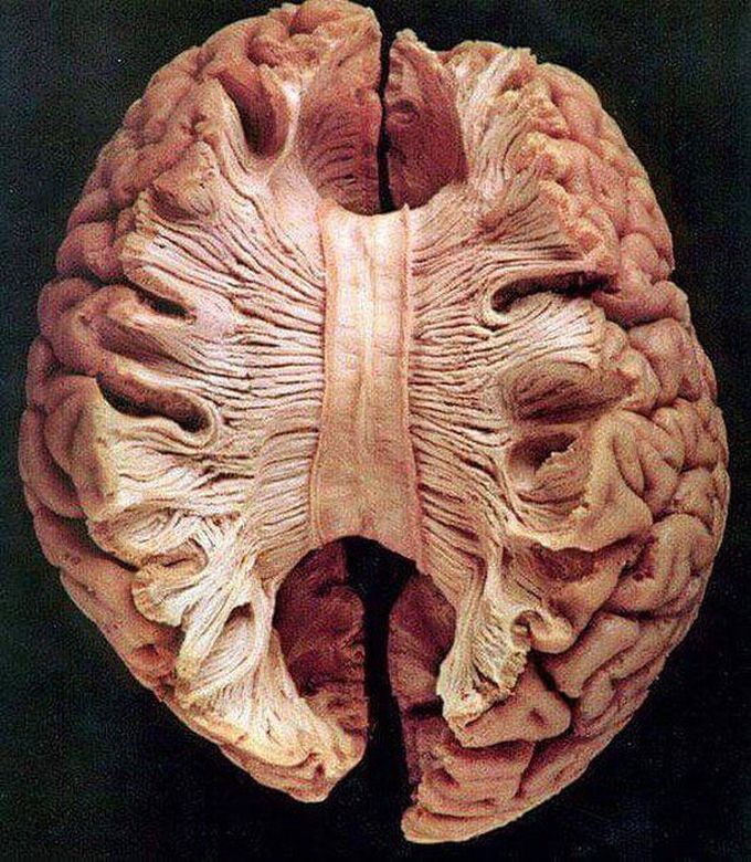 Corpus callosum