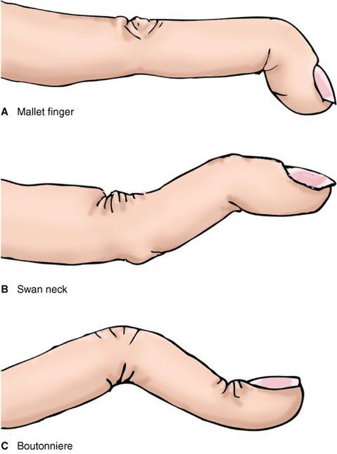 Deformities of the fingers