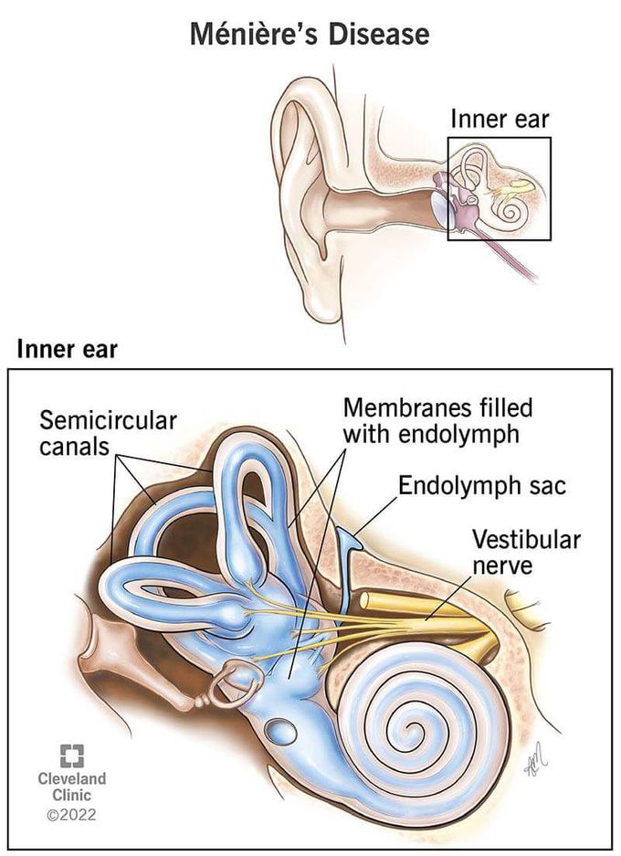 treatment of menieres disease