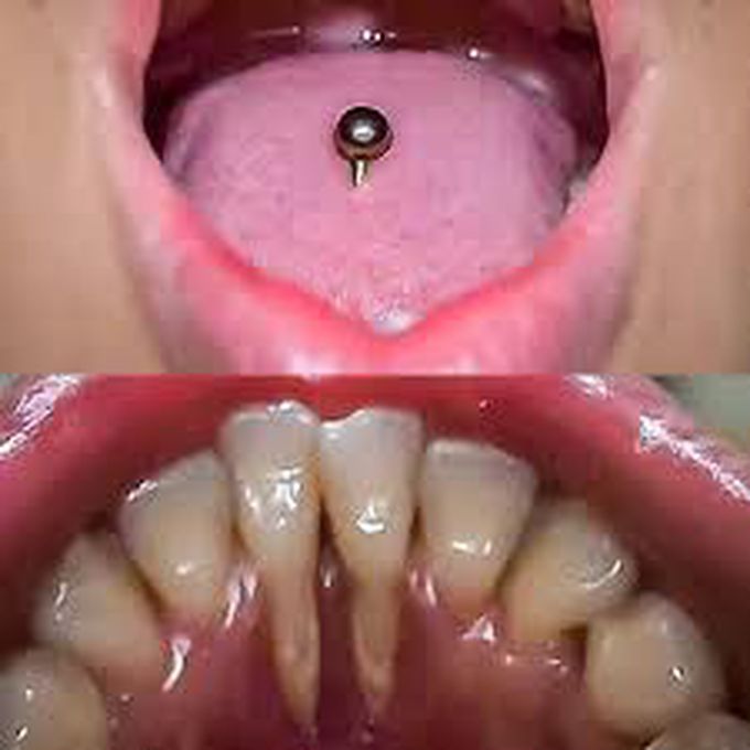 Effect of tongue piercing on gums