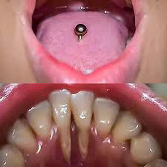 Effect Of Tongue Piercing On Gums Medizzy