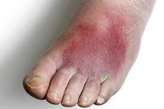 Cellulitis