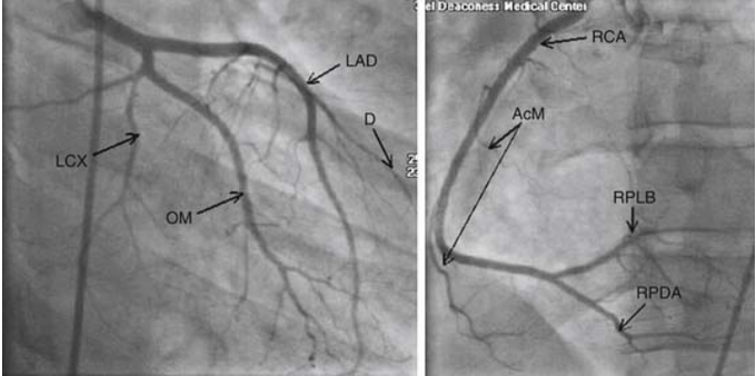 Left Coronary Arteriogram