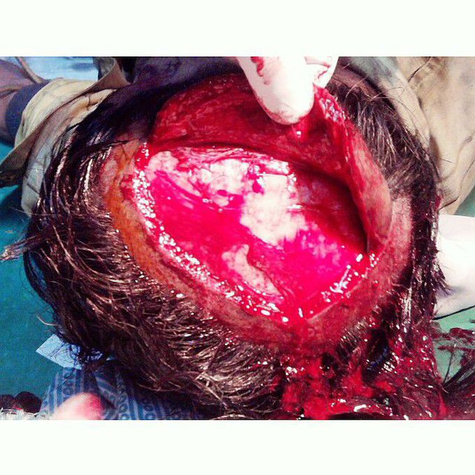 Severe injury to the scalp