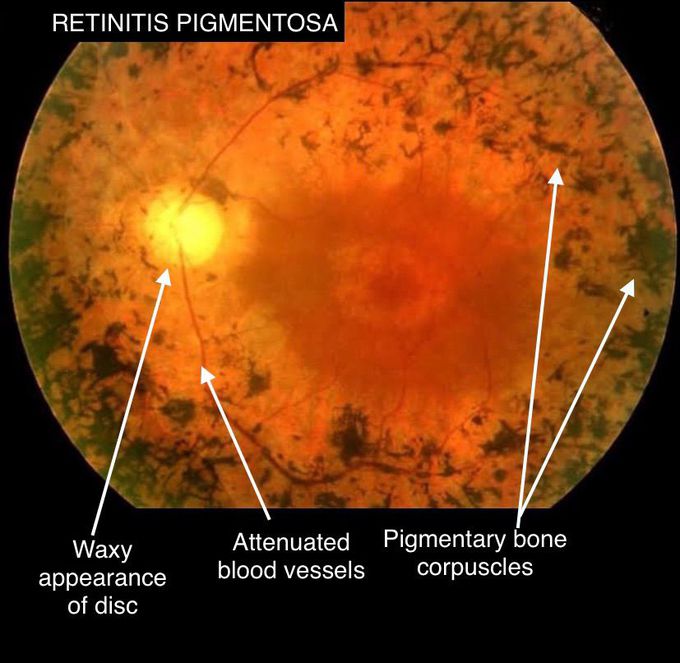Retinitis pigmentosa - MEDizzy