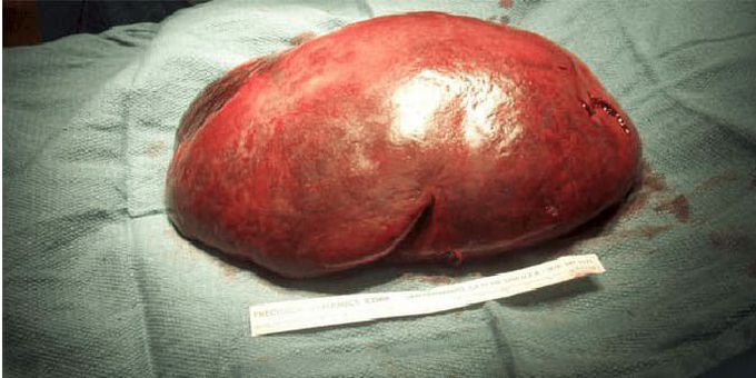 MASSIVELY ENLARGED SPLEEN