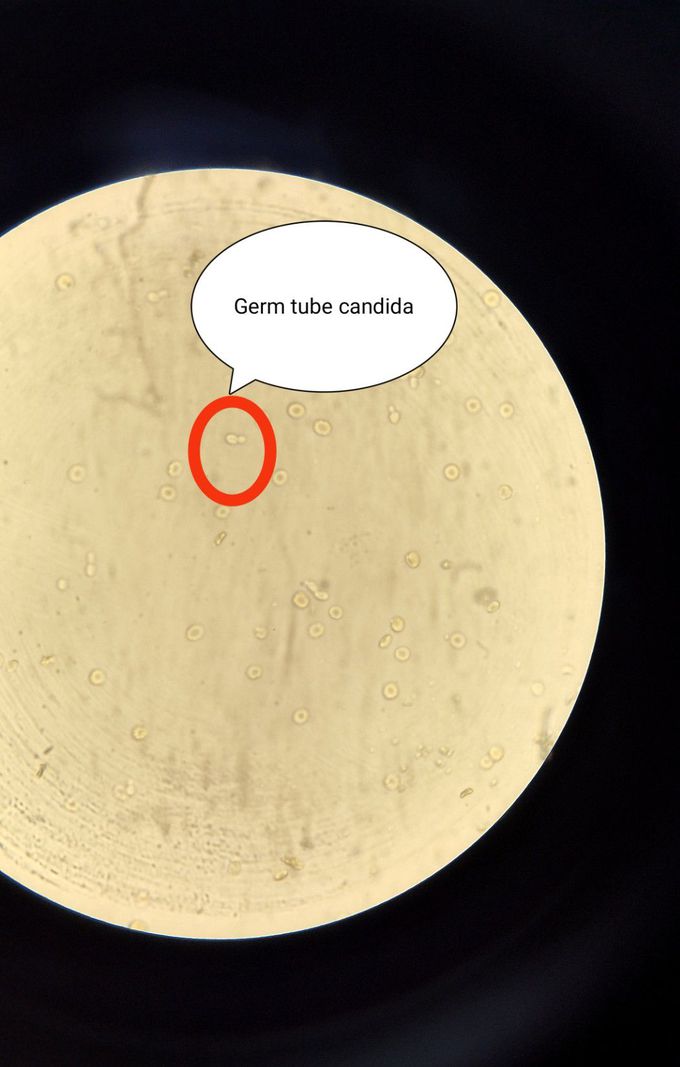 Germ tube Candida
