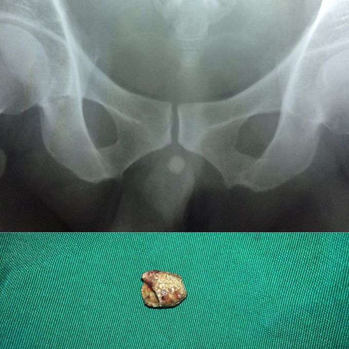 Urinary stone impaction on distal urethra