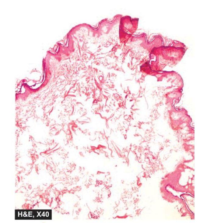 Fibroepithelial polyp (acrochordon or soft fibroma).