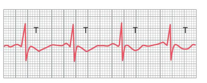 Ischemia of ventricles