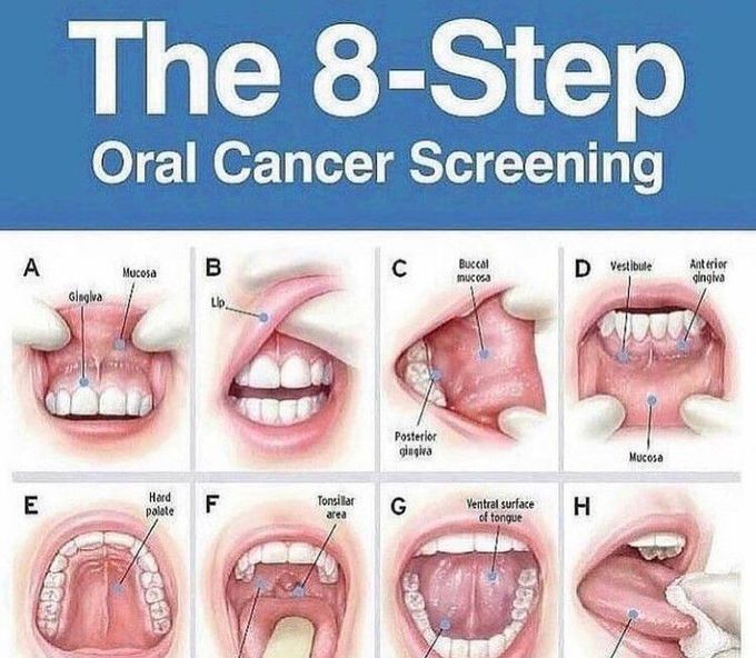 Oral cancer screening