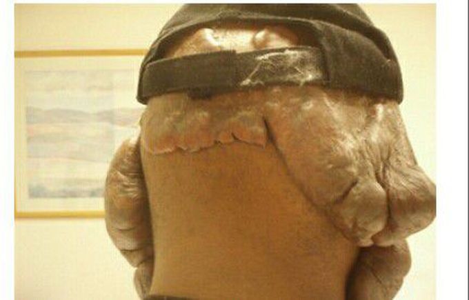 Keloid