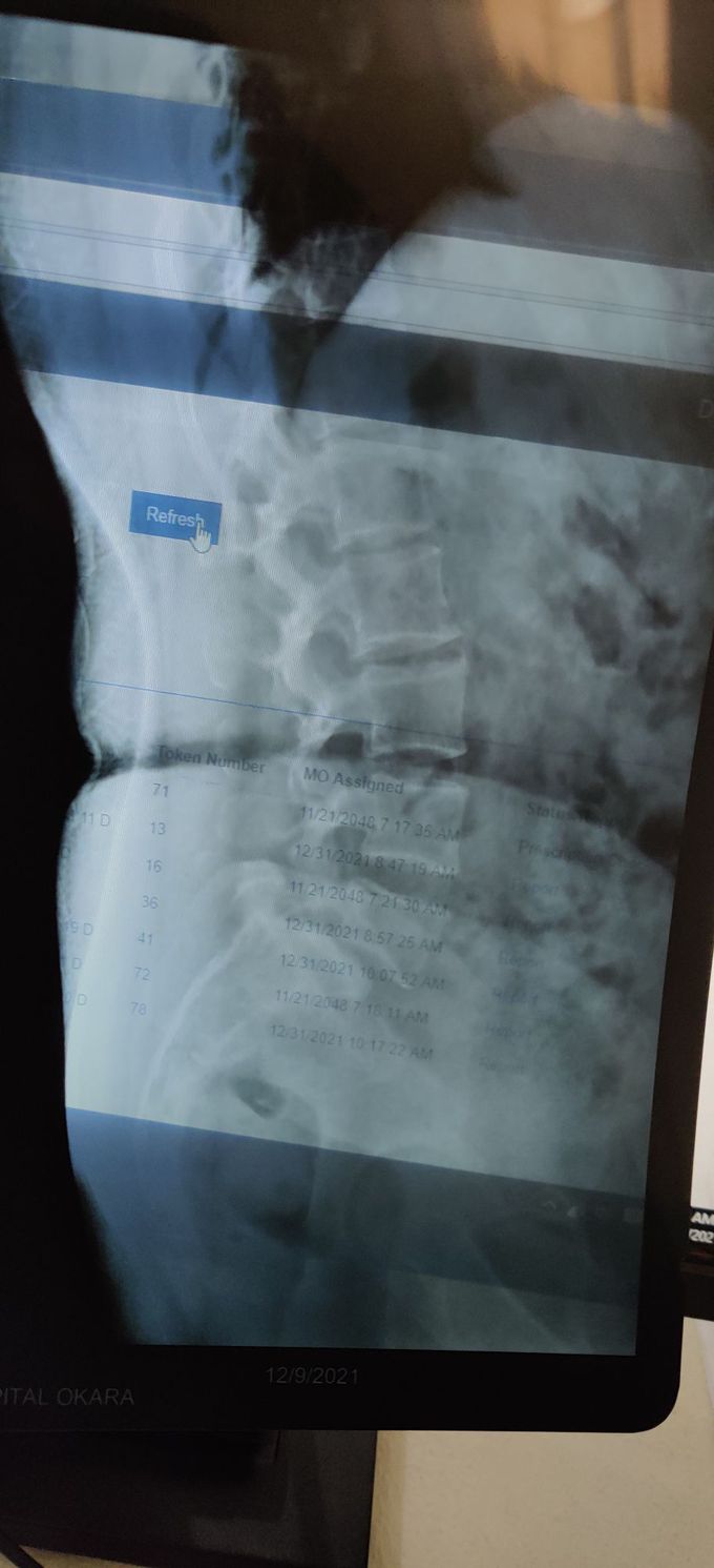 Lumbosacral spondylosis with spondylolisthesis