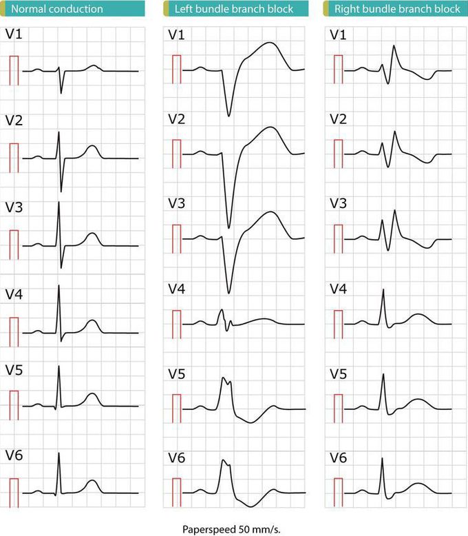 ECG variations