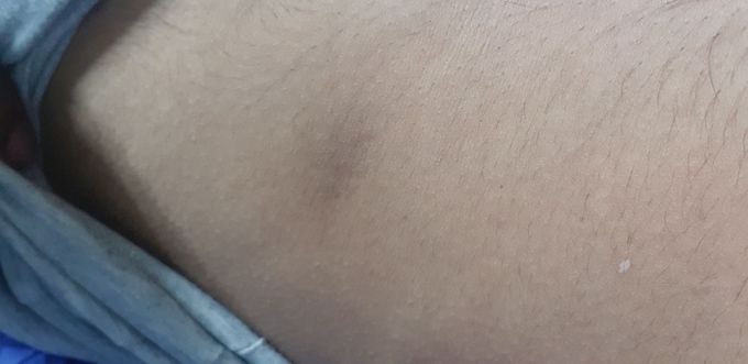 Whaths the diagnosis? Patient complains of mild numbness over that area, itchy once touched. Location : at right side of his ribs area