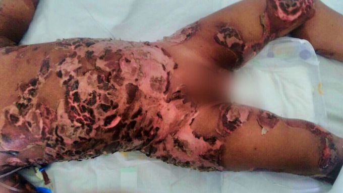 10yr old Girl with Ritter‘s disease