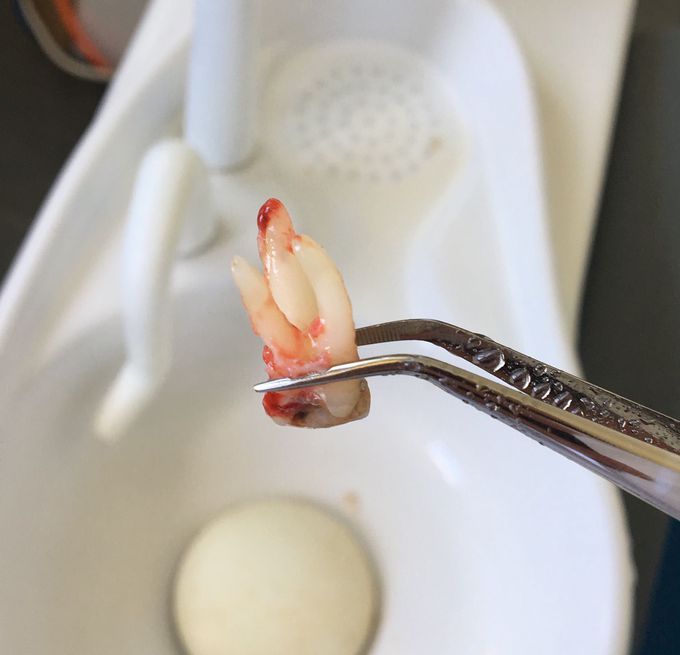 First molar