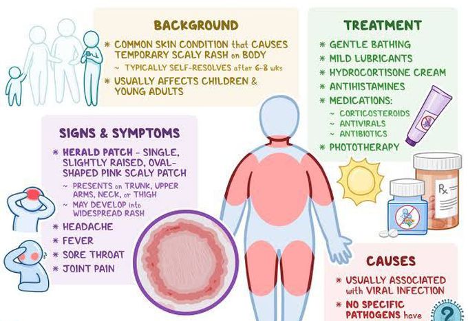 Pityriasis rosea