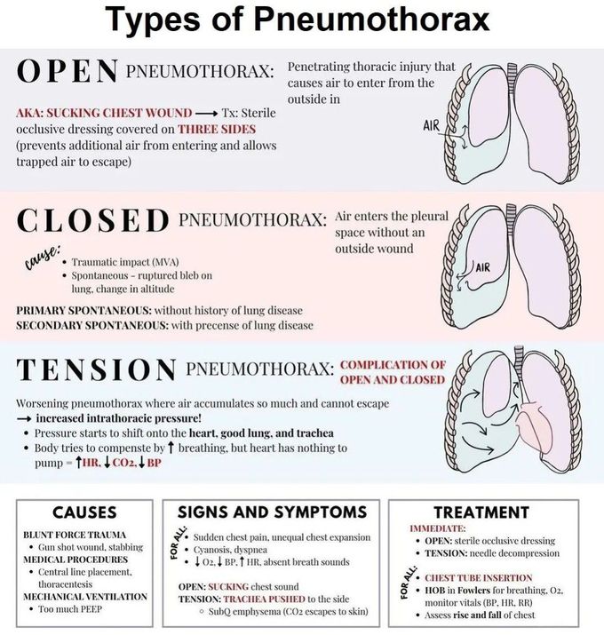 Types of Pneumothorax