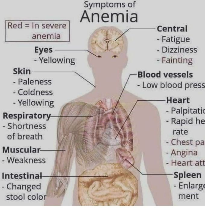 Anemia