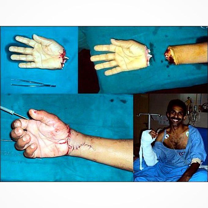 A wrist amputation due to an industrial accident