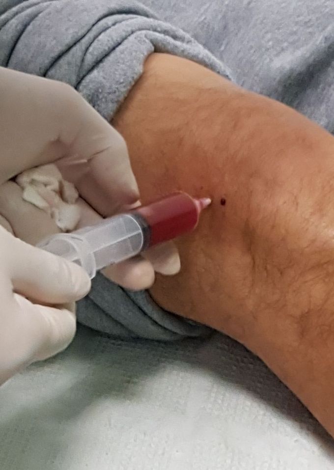 knee synovitis   //
aspiration of synovial fluid