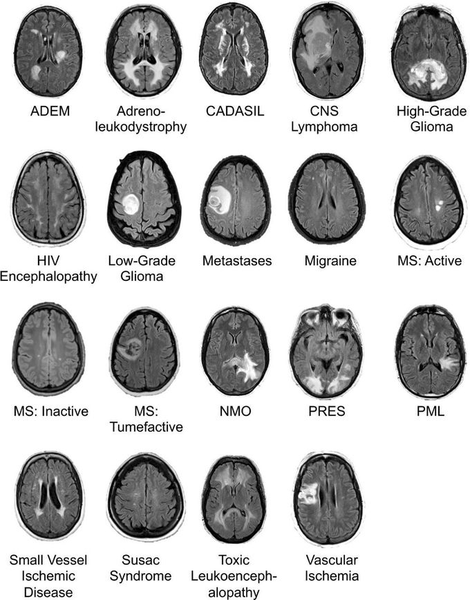 MRI of brain