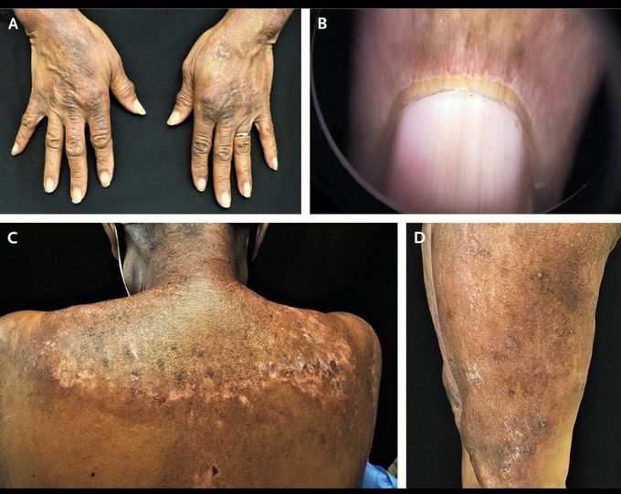 Dermatomyositis