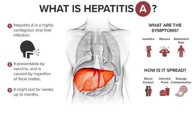 Hepatitis A