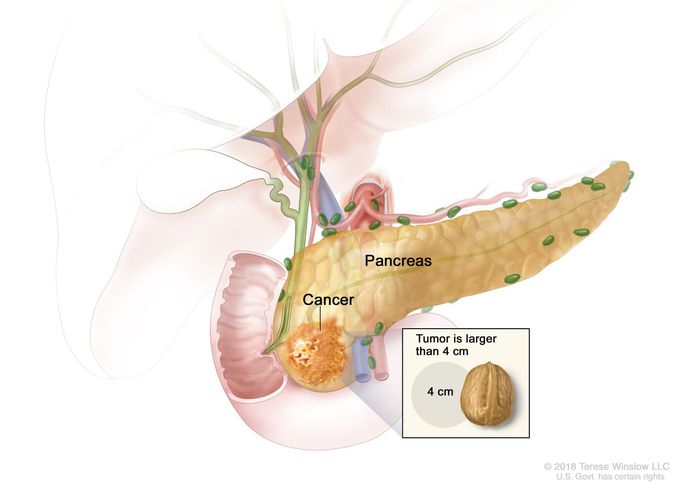 Pancreatic cancer