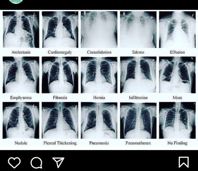 Different lung diseases in radiograph