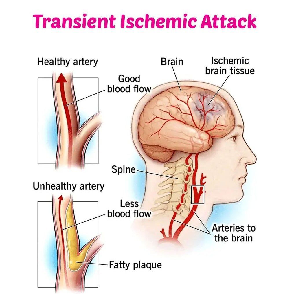 transient-ischemic-attack-medizzy