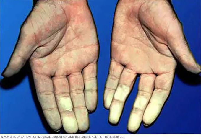 Raynaud's disease