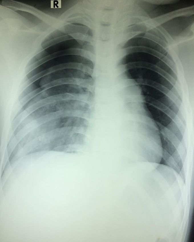What supposed to be the diagnosis ?