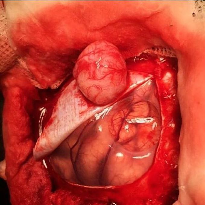 Meningioma attached intradurally and the site of cerebral compression