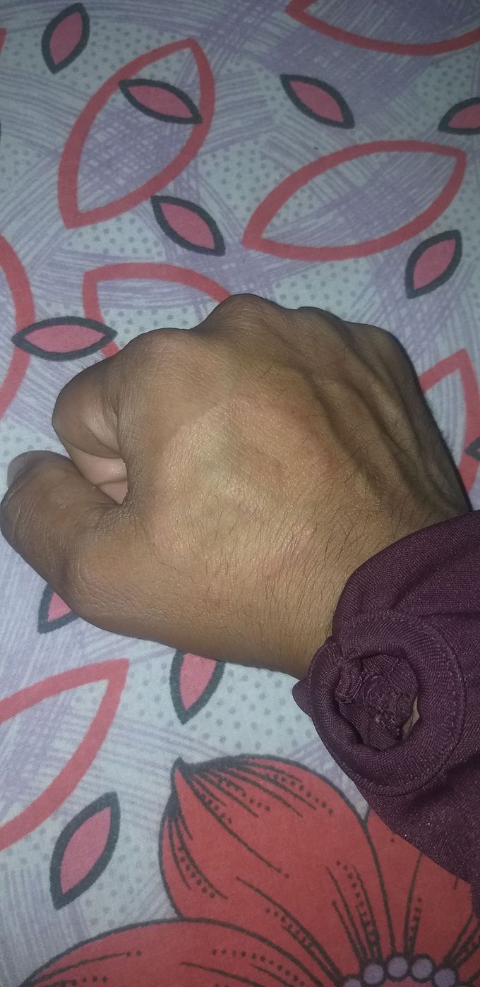 A 26-year-old boy who had itching on the side of the thighs for 2 months. Then from 1 month itching occurred on the inverted hand, then on the toes. For which he took Clotrimazole ointment 2%, Avil Injection and tablet  antihistamine but did not get any rest. So what treatment will we give him so that he can get rest.
