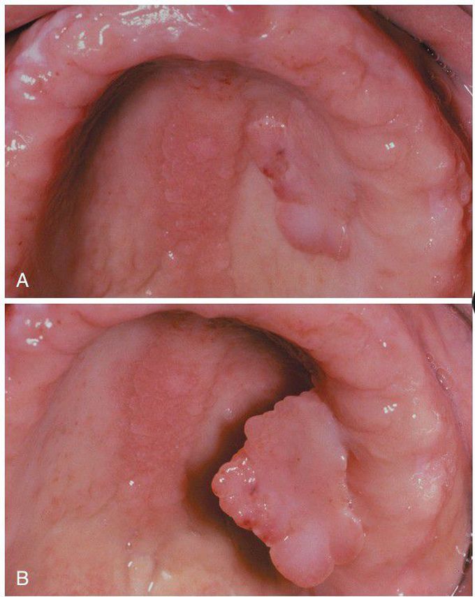 Fibroepithelial Polyp.