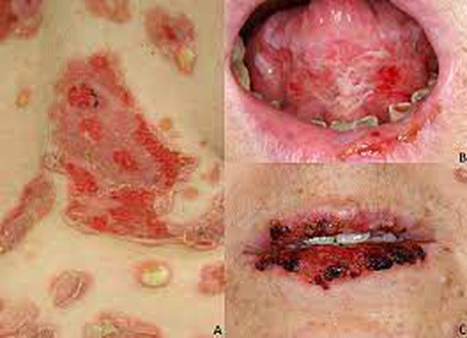 Symptoms of Pemphigus