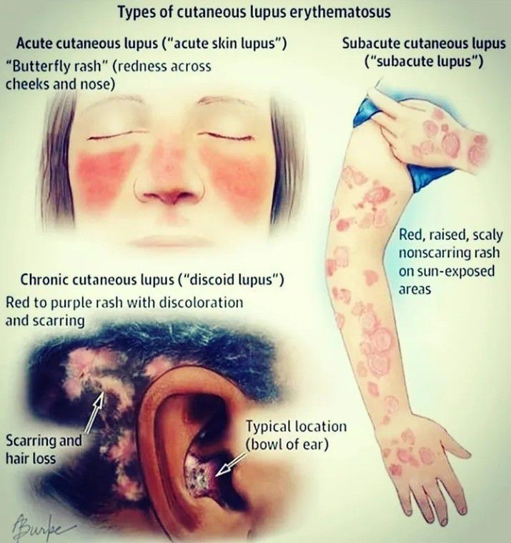 Cutaneous Lupus Erythematosus Medizzy 1994