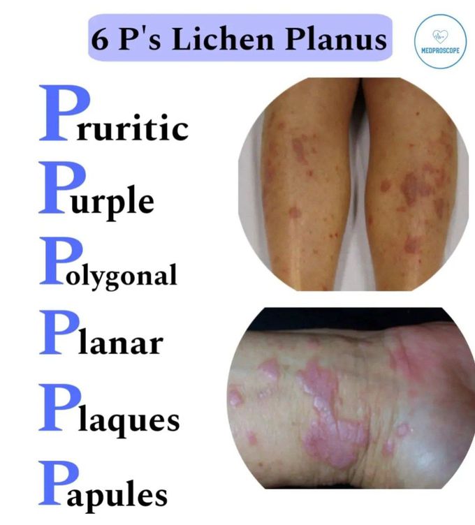 6Ps of Lichen Planus