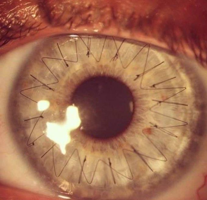 Stitches in eye after corneal transplantation.