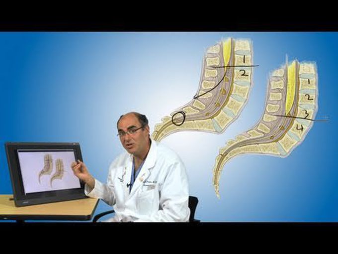 Tethered Cord Syndrome--Neural Tube Defect
