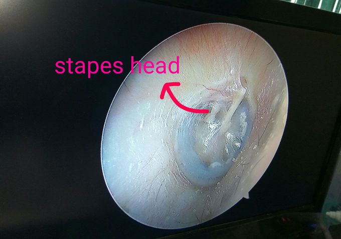 Ear endoscopy